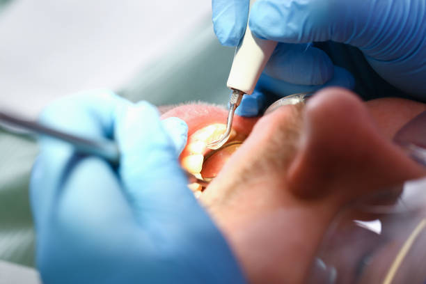 Best Emergency Wisdom Teeth Removal in West Jefferson, NC